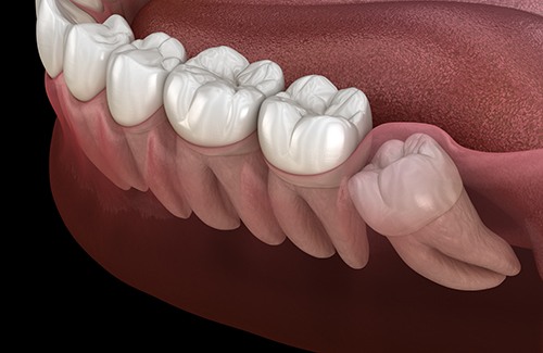 Illustration of wisdom tooth growing in